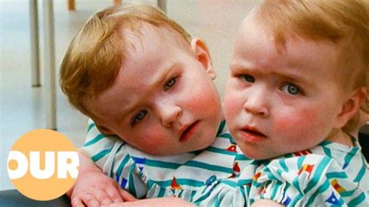 Exploring the Fascinating World of Eilish Conjoined Twin: A Journey of Identity and Connection